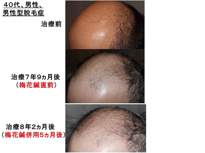 円形脱毛症　病院
